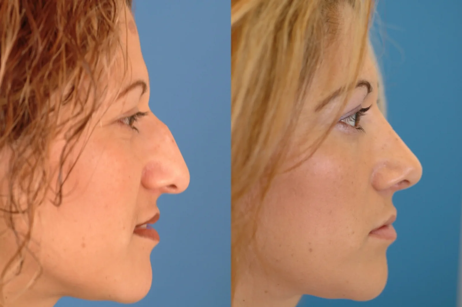 Aesthetic Nose Surgeries