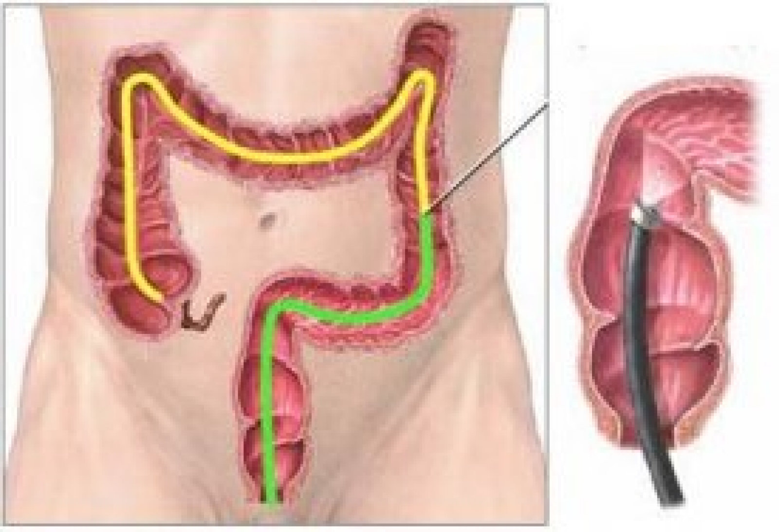 Rectosigmoidoscopy