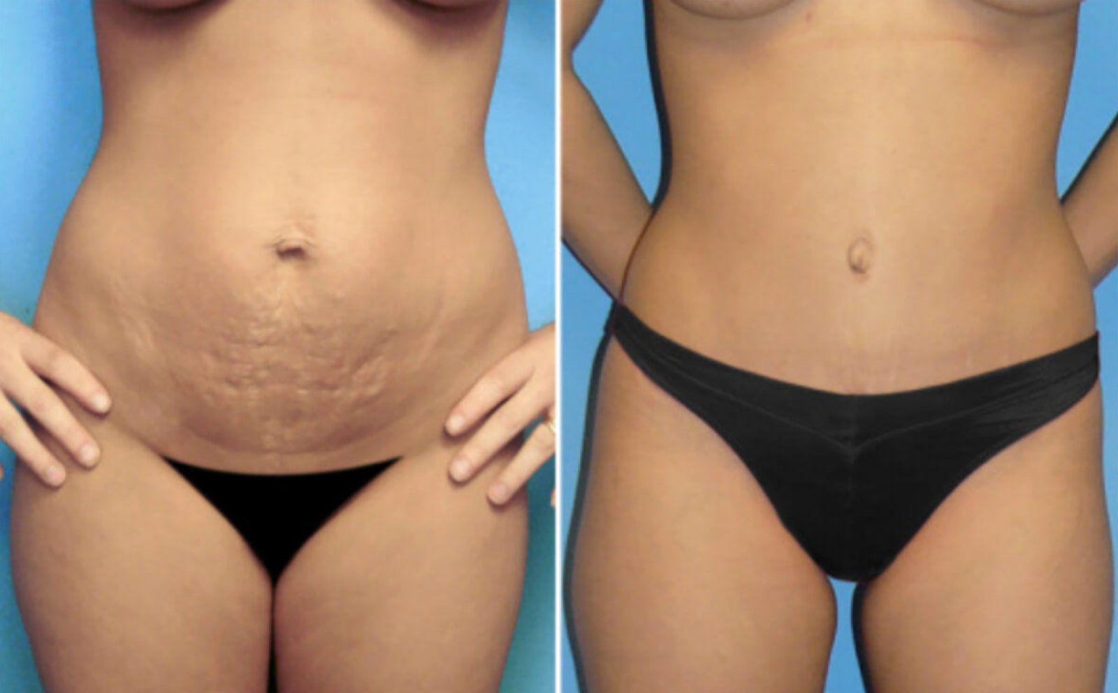 Tummy Tuck (Abdominoplasty)