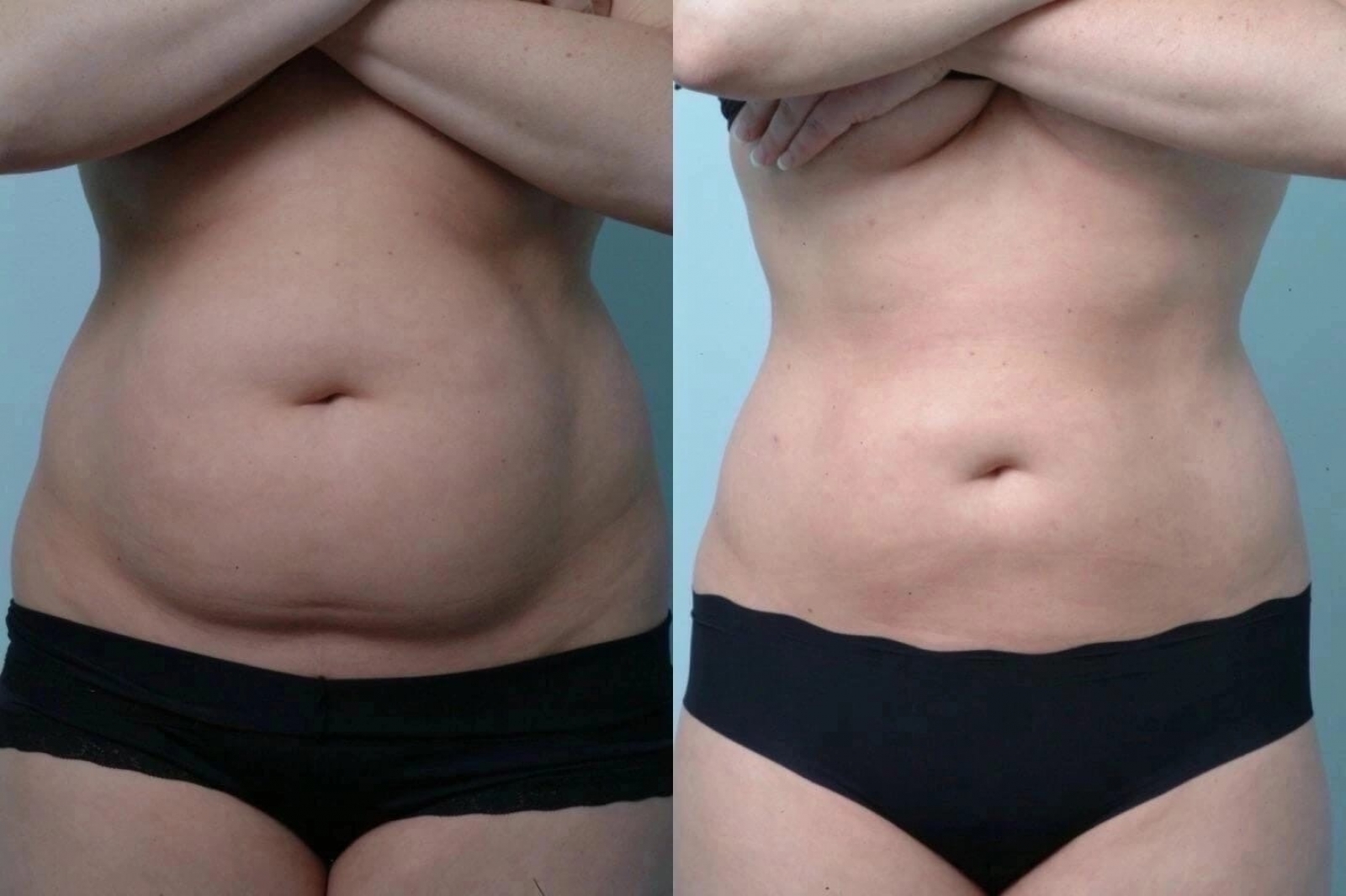 Tummy Tuck (Abdominoplasty)