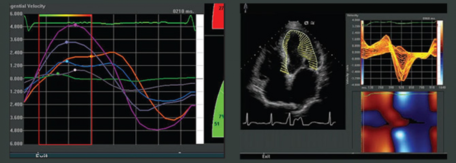 Echocardiography (Echo)