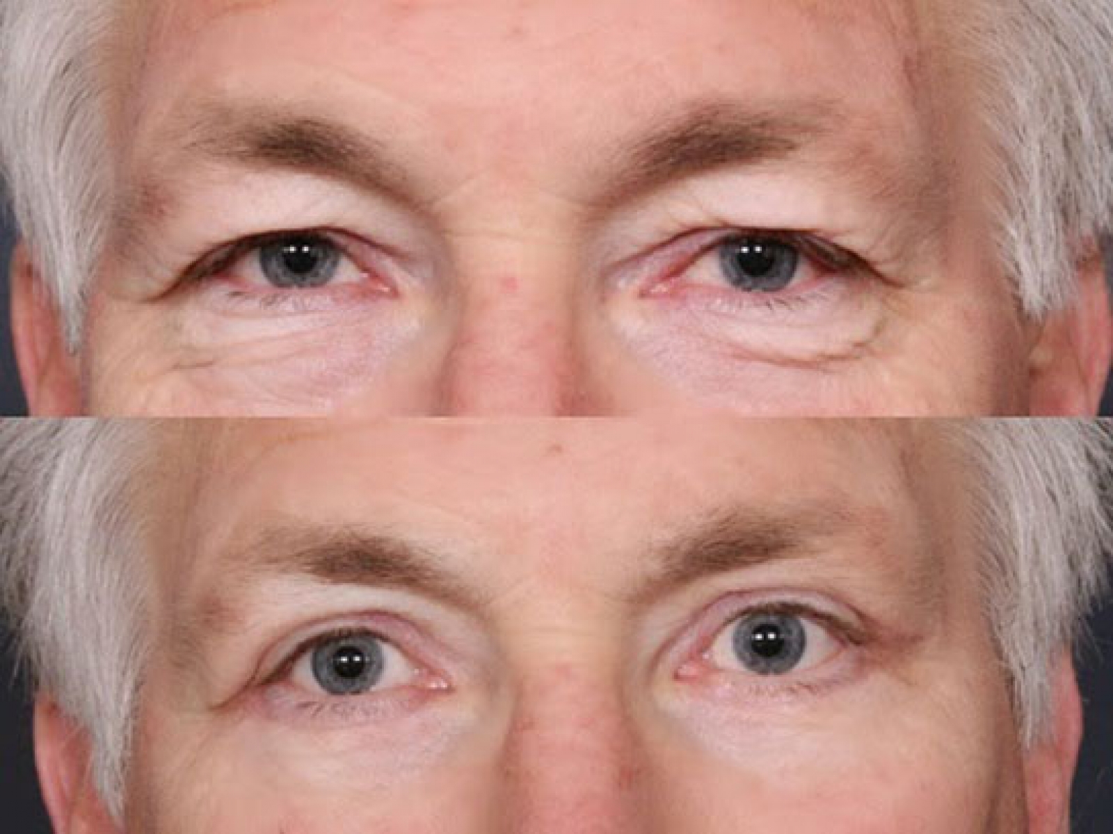 Eyelid Plastic Surgeries