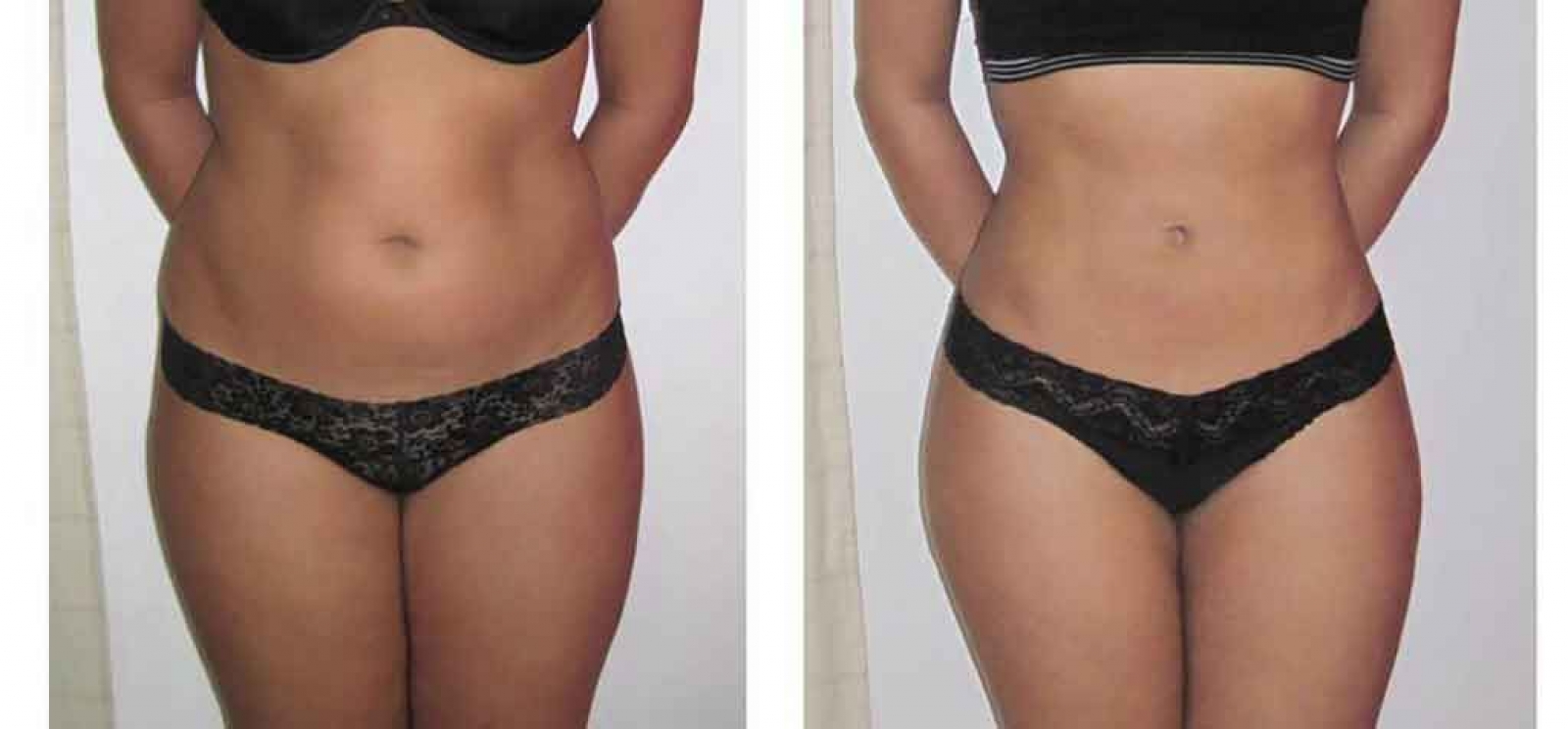Liposuction (absorption of excess fat from various parts of the body)