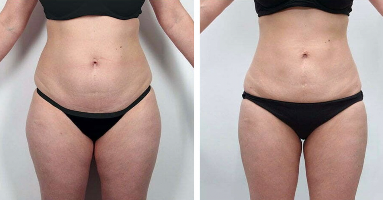 Liposuction (absorption of excess fat from various parts of the body)