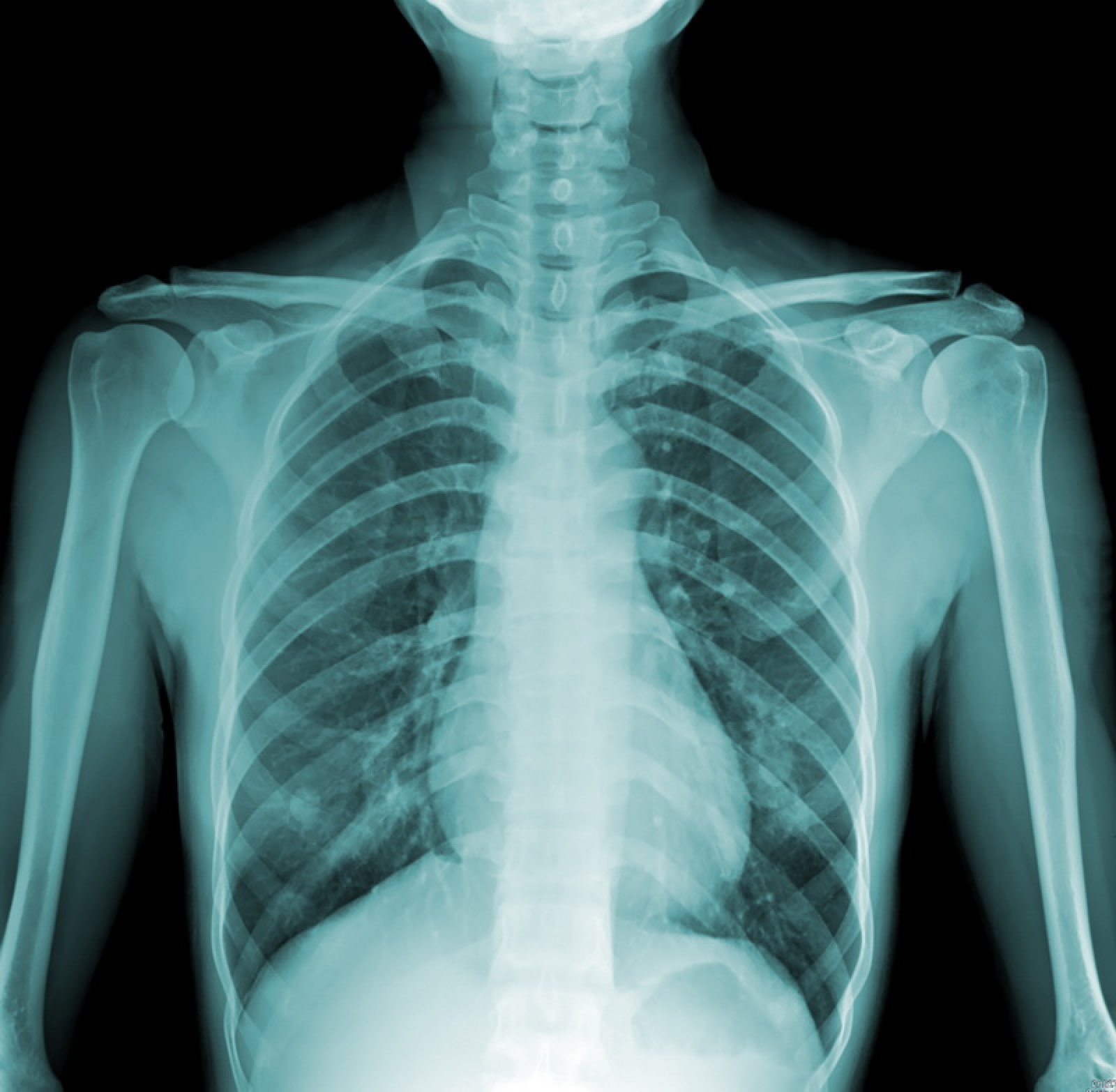Снимок. Рентген легких ковид 19. Рентген снимок грудной клетки. Рентген области грудной клетки. Рентген снимки грудной клетки.